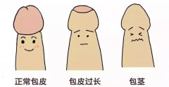 固原包皮过长的治疗方法