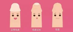 包皮过长该如何护理呢？