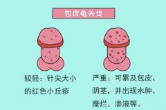 严重的龟头炎能治好吗？”